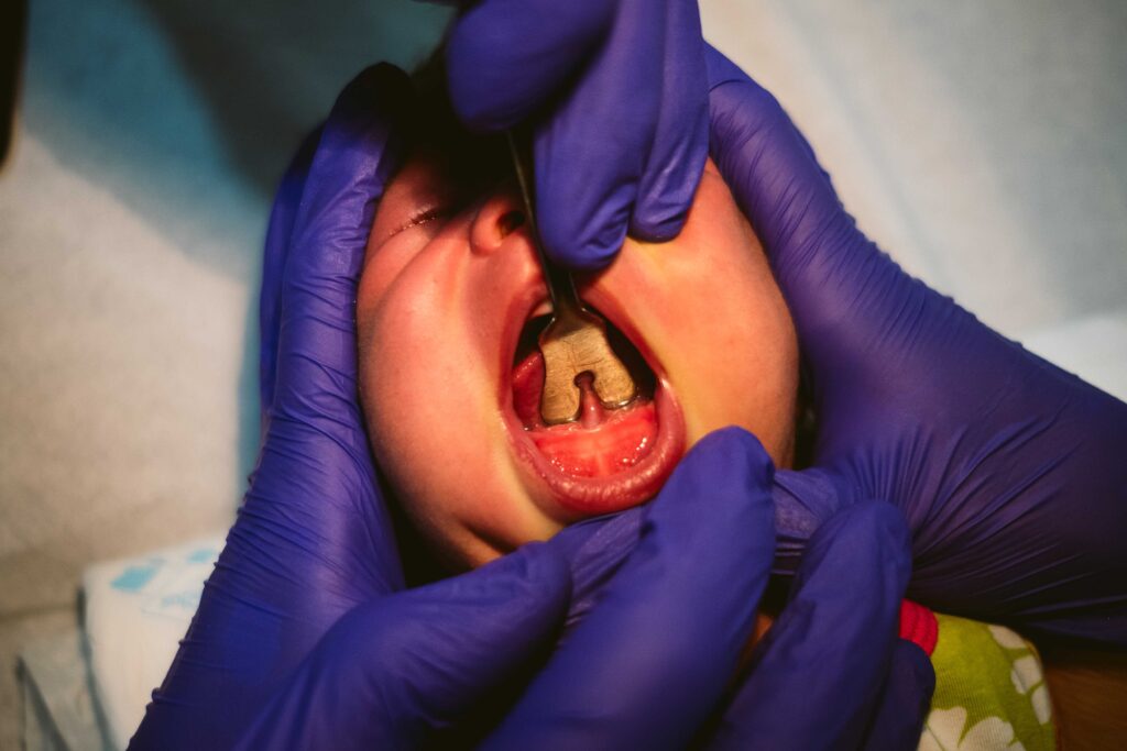 A dentist holding up a baby’s tongue